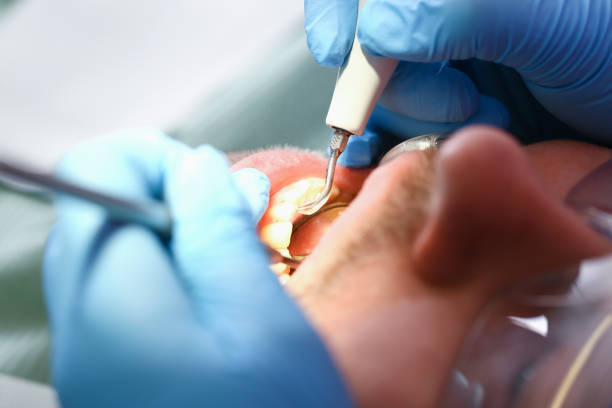 Best Chipped Tooth Repair Near Me  in Tanglewilde, WA